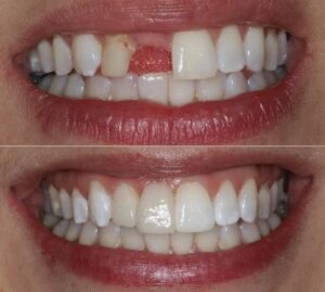 Smile Makeover