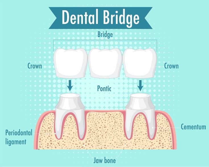 Dental Crowns and Bridges Treatment in Madinaguda