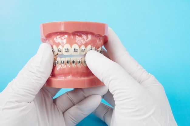 Best Braces Dentist in Madinaguda