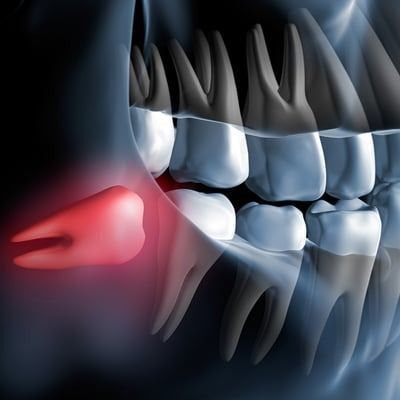 Wisdom Tooth Removal in Madinaguda