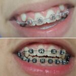 Teeth Braces Before and After