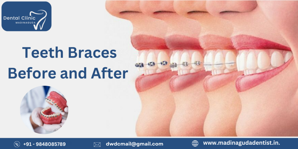 Teeth Braces Before and After