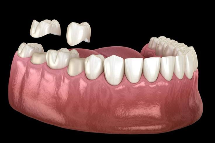Crowns Treatment in Madinaguda