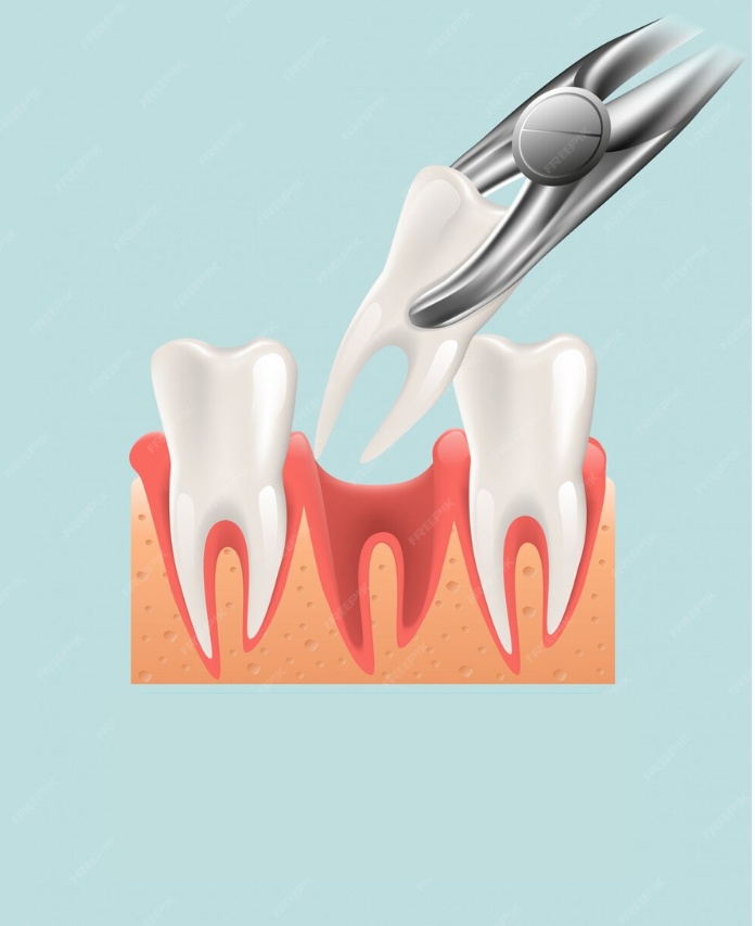wisdom tooth removal in madinaguda