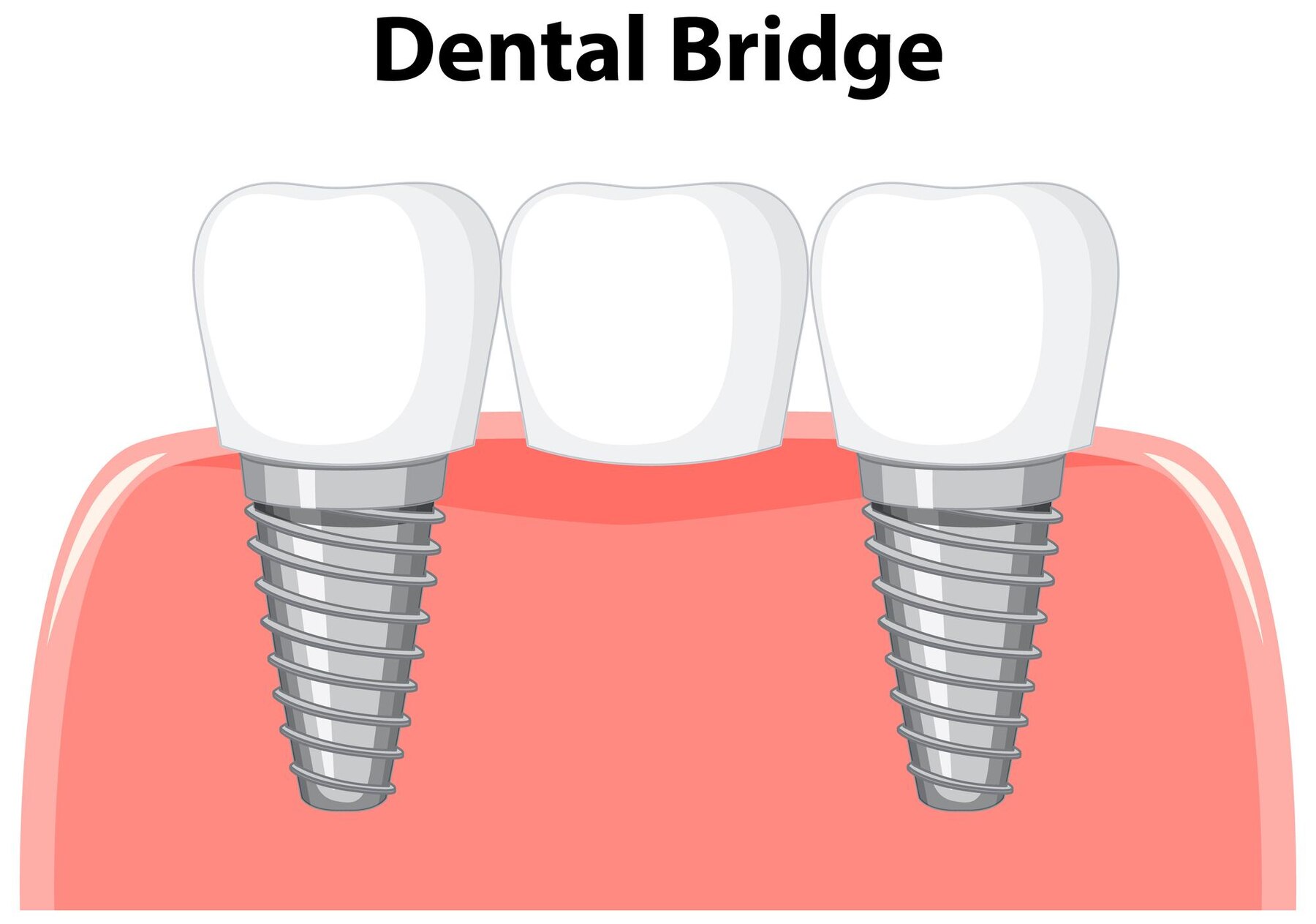 Dental Bridge Treatment in Madinaguda