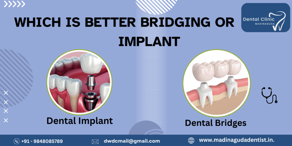 Which is Better Bridging or Implant