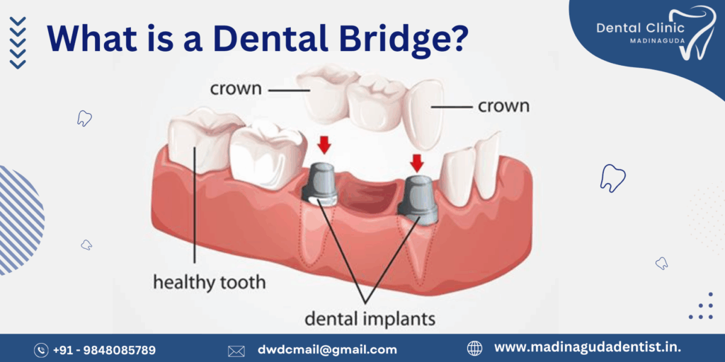 Which is Better Bridging or Implant