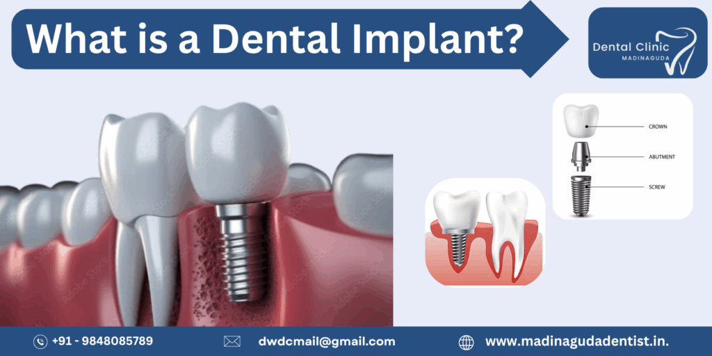 Which is Better Bridging or Implant