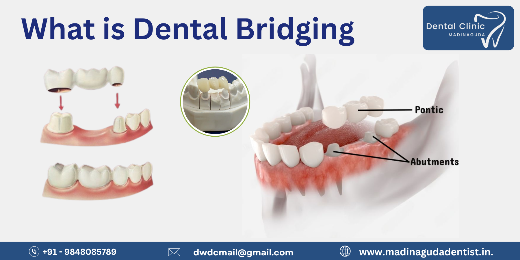 What is Dental Bridging