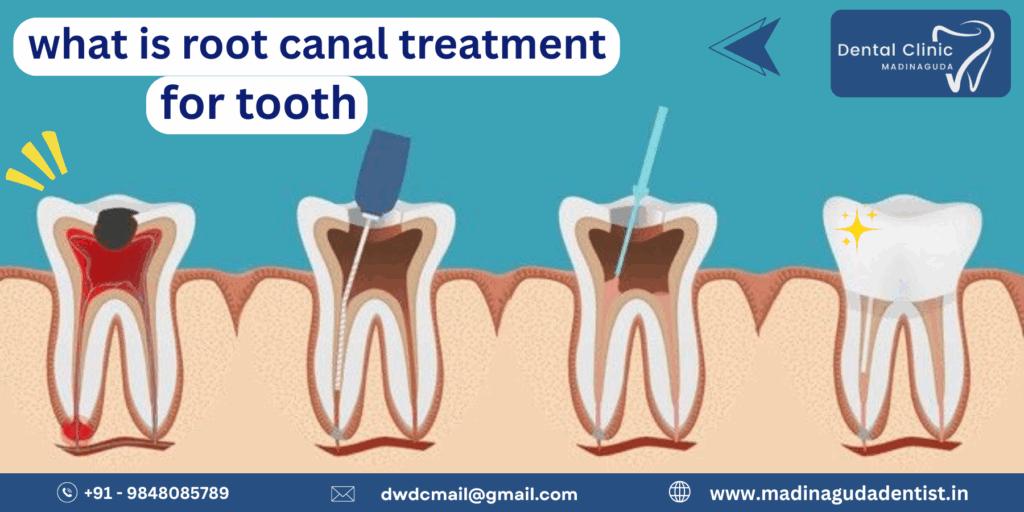 What is Root Canal Treatment For Tooth