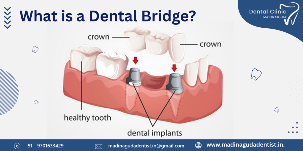 Which is Better Bridging or Implant