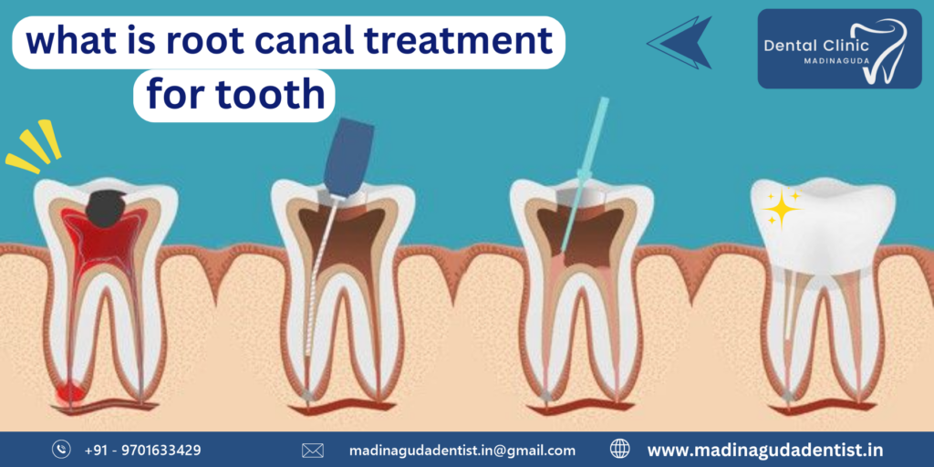 What is Root Canal Treatment For Tooth