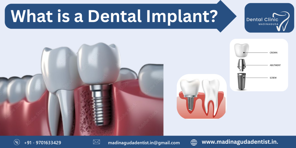 Which is Better Bridging or Implant