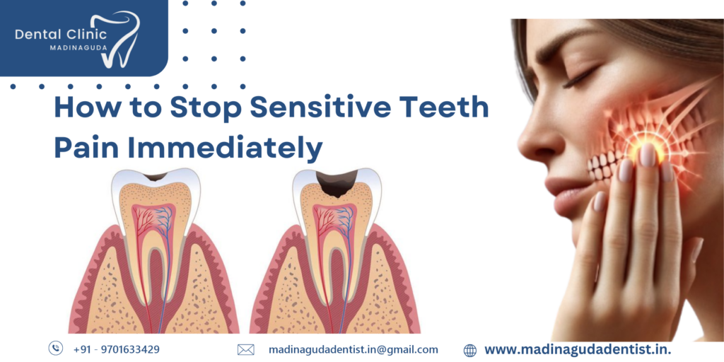 If you're wondering how to stop sensitive teeth pain immediately, you can try using special toothpaste made for sensitive teeth, rinse your mouth with warm salt water, and avoid very hot or cold foods. But if the pain doesn’t go away, it’s a good idea to visit your dentist to find out what’s causing the problem and get the right treatment.