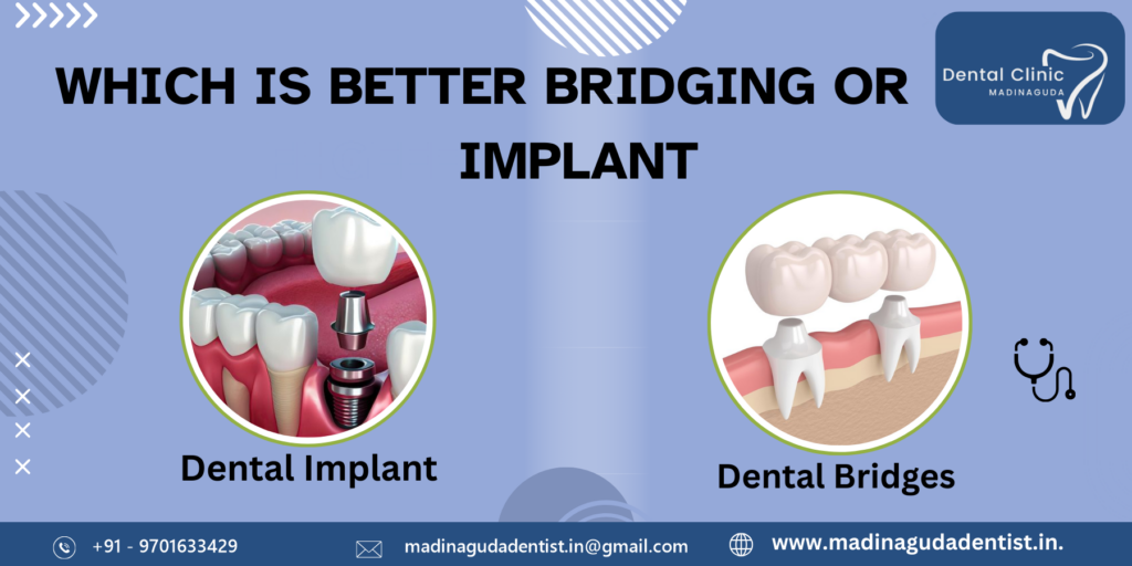 Which is Better Bridging or Implant