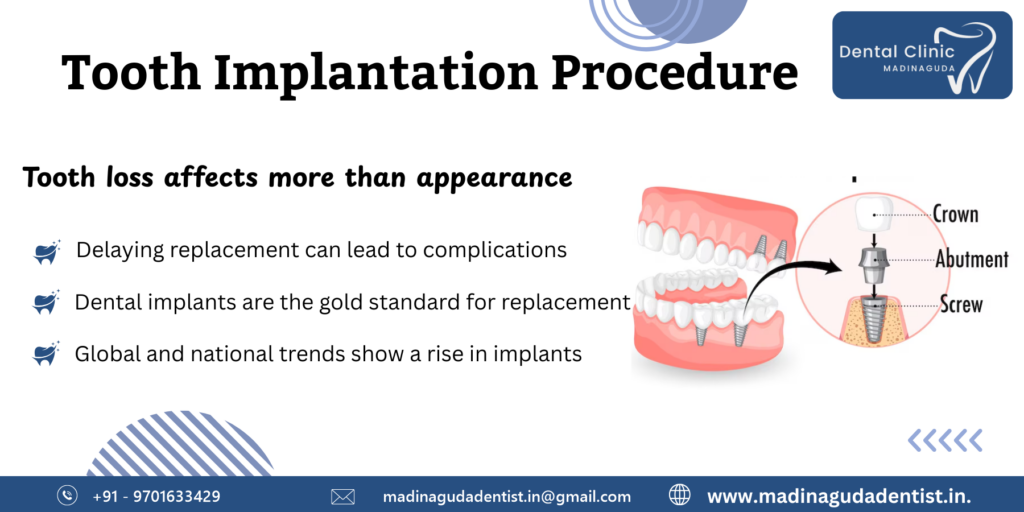 Tooth Implantation Procedure